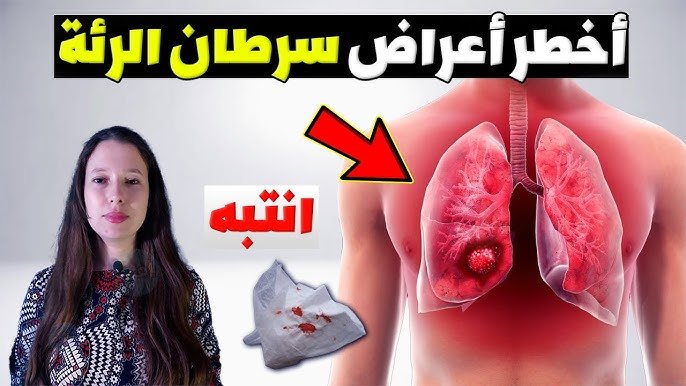 سرطان الرئة